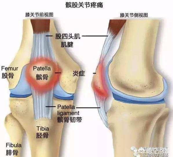 头条问答 膝关节滑膜炎患者该怎样运动才有益身体健康 12个回答