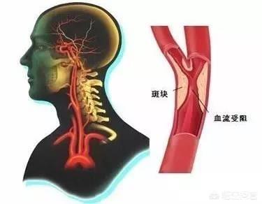 血管不通的症状,心脑血管堵塞有哪些先兆？