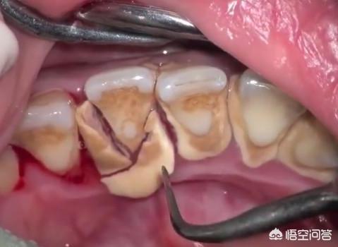 牙结石洗牙多少钱:牙结石洗牙多少钱一颗 有少量牙结石需要洗牙吗？