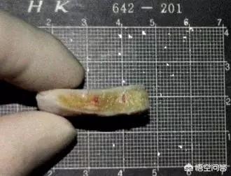 鼻综合手术拆线多少钱:鼻综合诊所拆线大概多少钱 鼻部整形中隆鼻和鼻综合整形具体有什么区别？