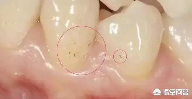 儿童四环素牙怎么治:儿童四环素牙怎么治疗 三岁小孩吃消炎药（头孢、阿奇、罗红霉素）一般几天一疗程？