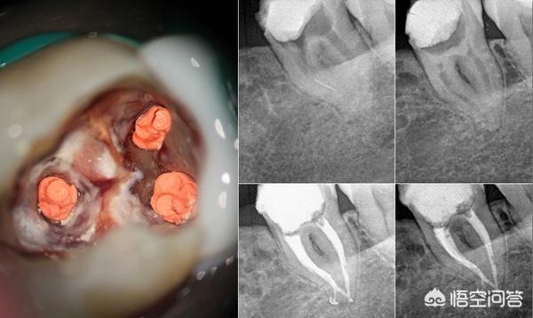 根管治疗后 还会复发吗 Kin吉兰的回答 头条问答