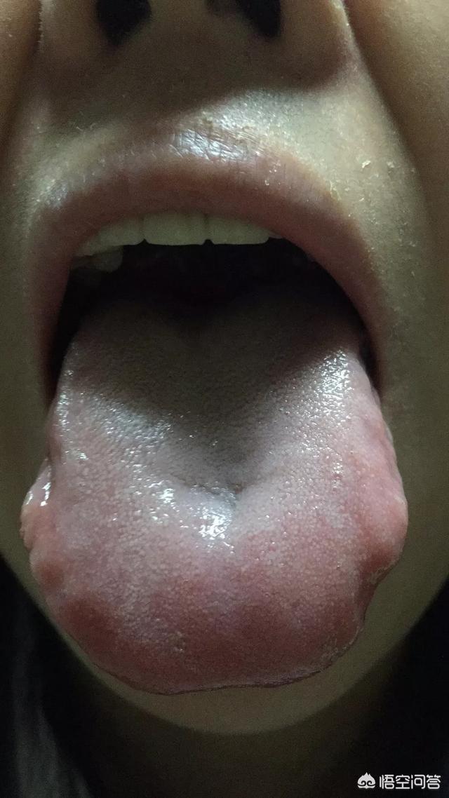 舌頭胖大有齒痕，需要怎麼調理？