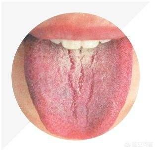 裂舌(裂口女)