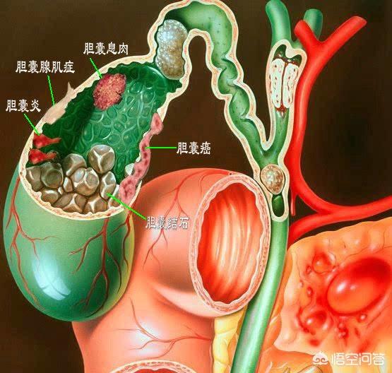 外科疾病总结:有哪些胆囊疾病呢？该怎样预防呢？