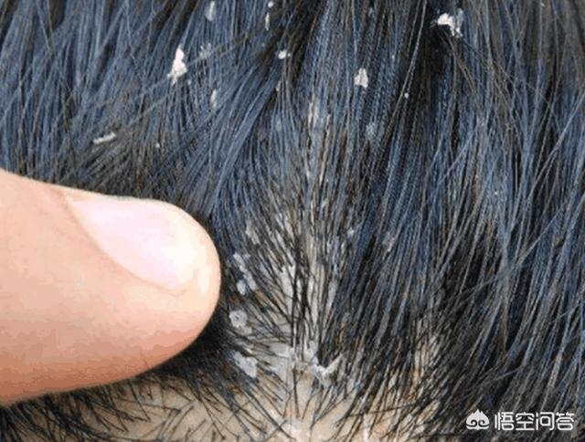 螨虫的症状:怎么正确判断头上是否有螨虫？