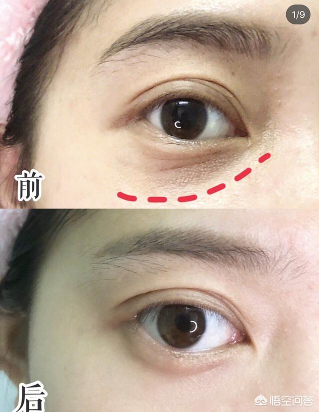 头条问答 - 什么是细纹什么是干纹?(3个回答)