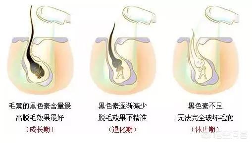 脱毛膏:脱毛膏的利弊 脱毛膏有能永久脱毛的吗？