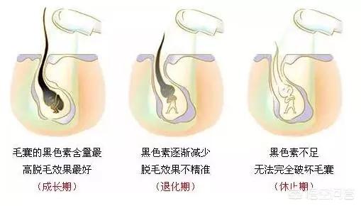 永久脱毛:脱毛膏有能永久脱毛的吗？