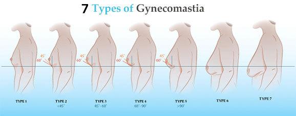 头条问答 - 为什么男人也会患乳腺癌?(20个回答)