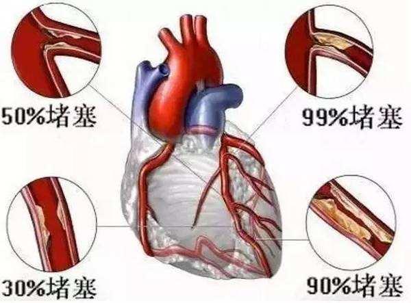 心脏血管堵塞有什么症状 怎样疏通血管 二次元少女的幽默细胞的回答 头条问答