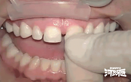 牙缝太大怎么办:牙缝变大怎么办