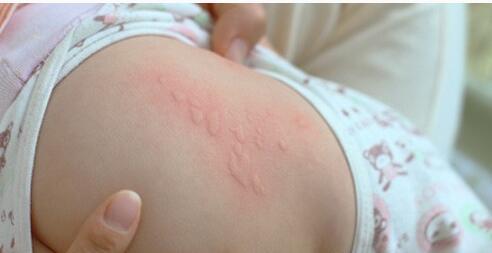 过敏性荨麻疹几天能好