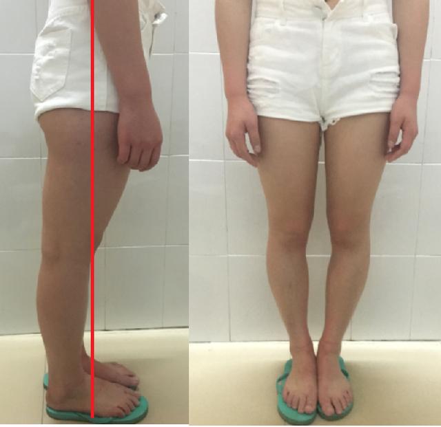 罗圈腿矫正(罗圈腿矫正手术大概需要多少钱)