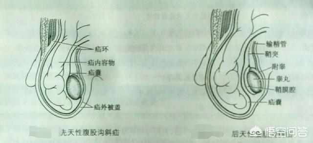 内脏器通过腹股沟区的缺损向体表突出所形成的囊性包块,俗称"疝气"