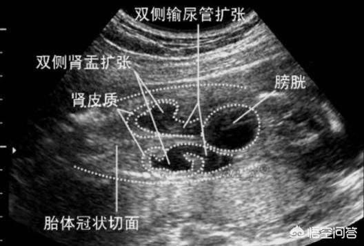 胎儿肾积水怎么办(7个月胎儿积水有什么影响吗)