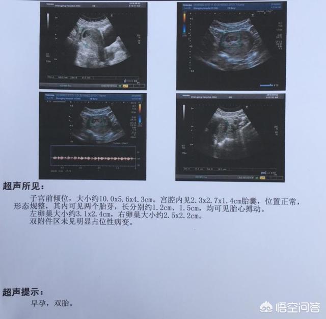 头条问答 一个孕囊两个胚芽 是双胞胎吗 If枕边育儿的回答 0赞