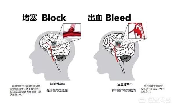 脑血栓来临前有哪些前兆，听说脑梗在到来前早就有了先兆，这是真的吗