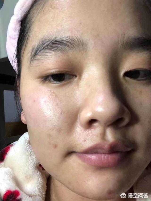 头条问答 - 我19岁,脸是油性和一些痘印,痘坑,可以用什么护肤品来护理