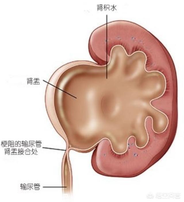 只有一个肾而且还积水:只有一个肾得了肾积水 如果单侧肾积水了，排尿还会通畅吗？