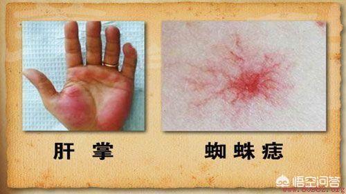 肝硬化呕血便血的原因:肝硬化患者出现呕血便血的原因 出现肝硬化的“8大征兆”是什么？