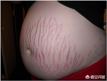 怀孕多久会长妊娠纹？为什么会长妊娠纹？插图31