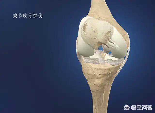运动过量膝盖痛怎么办,过量的运动会损害膝关节吗？