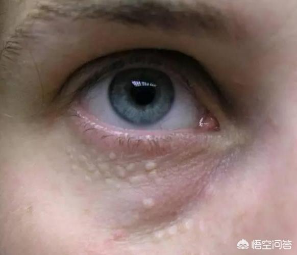 脂肪粒怎么去除脂肪粒怎么去除小窍门