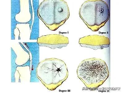 膝盖关节炎症状:怀疑膝关节炎如何自我检查？