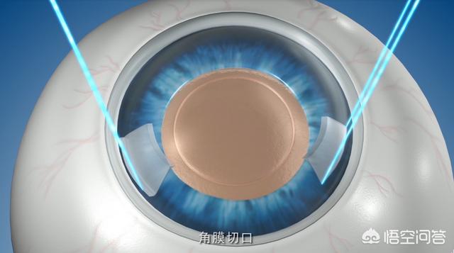 36岁的白内障的原因:30多岁得白内障原因 如何判断自己是否得了白内障？
