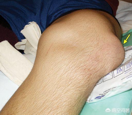 复发性髌骨脱位 概念:髌骨脱位的治疗方法是什么？