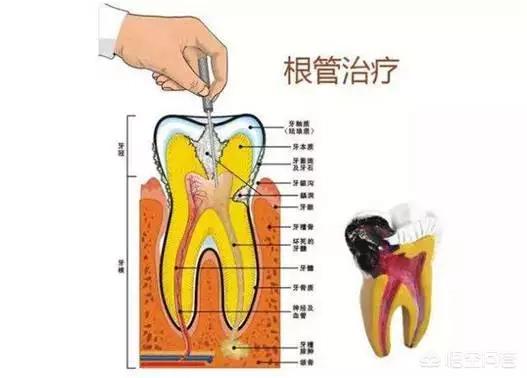牙齿折断牙根还有用吗:牙齿断了一大半，还有办法修复吗？