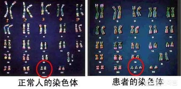 猫叫综合征:到泰国做第三代试管婴儿可行吗？
