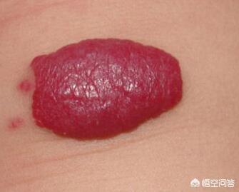 头条问答 - 宝宝身上的红色凸起的胎记是什么?有什么危害?(2个回答)