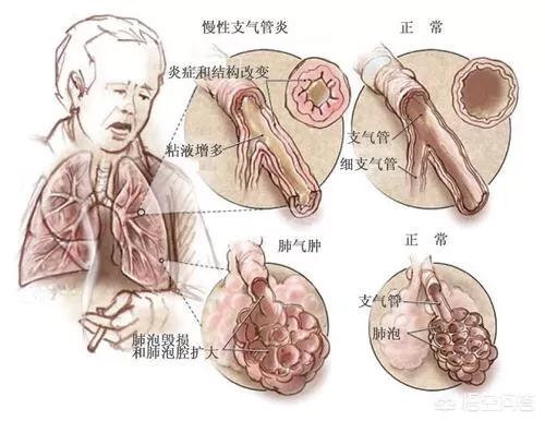 老年慢性支气管炎的症状_老年人慢性支气管炎什么症状_慢性炎症状气管支老年病变