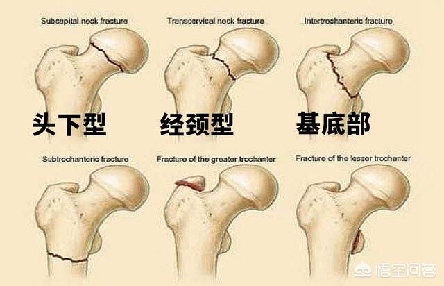 骨折治疗:骨折治疗的三大原则 古时候肋骨断了会怎样治疗？