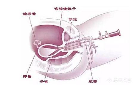 腹腔镜手术后注意事项:腹腔镜手术后注意事项及护理 宫腹腔镜微创手术后怎么调理能早点怀孕？