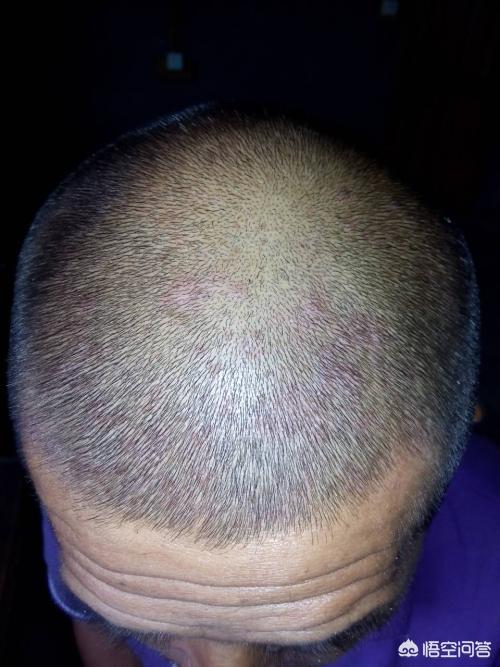 毛囊虫:脸上粉刺能挤出黄色颗粒是毛囊虫吗？