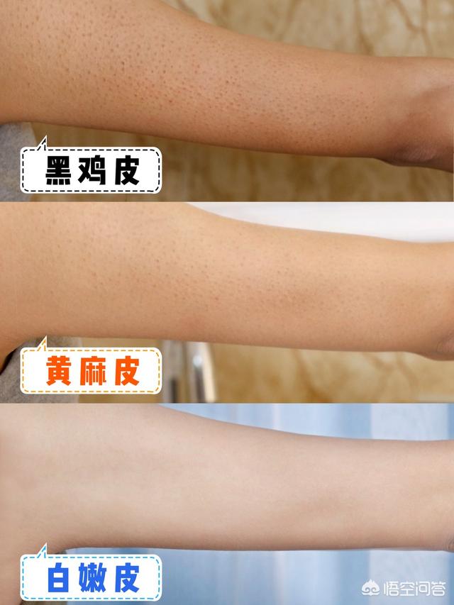 鸡皮肤保湿可以缓解吗(缓解鸡皮肤有什么好方法)