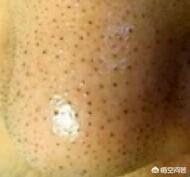 面部危险三角区:为什么鼻子长黑头不能用手挤有什么科学依据吗如何才能正确去黑头