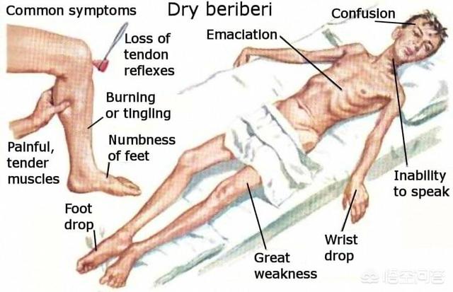 维生素b1缺乏病:缺乏维生素B1对孩子有什么影响？