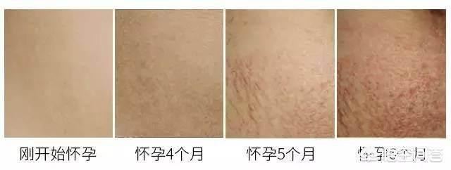 怀孕多久会长妊娠纹？为什么会长妊娠纹？插图30