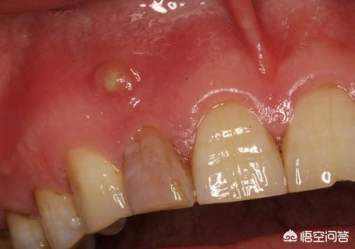 牙根肿发炎是怎么了