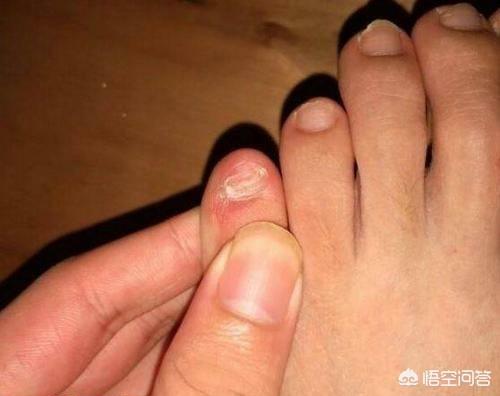 泰利氏指甲怎么治:小脚趾甲不全才是纯正血统的汉人吗？