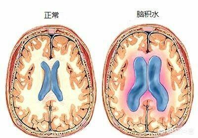 婴儿脑积水的症状:为什么一些宝宝刚生下来会有脑积水？