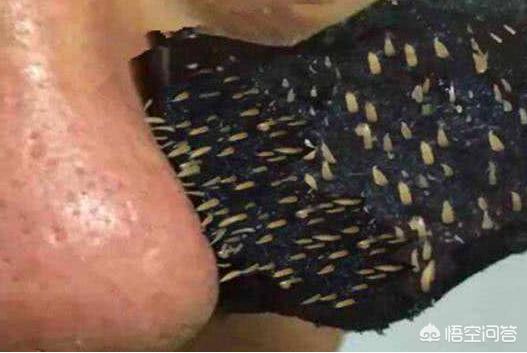 脸上挤出来的螨虫图片:百万螨虫天天在脸上打洞，该如何应对？
