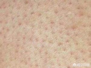 夏季皮肤问题图片:夏天如何改善“鸡皮肤”和“蛇皮肤”？
