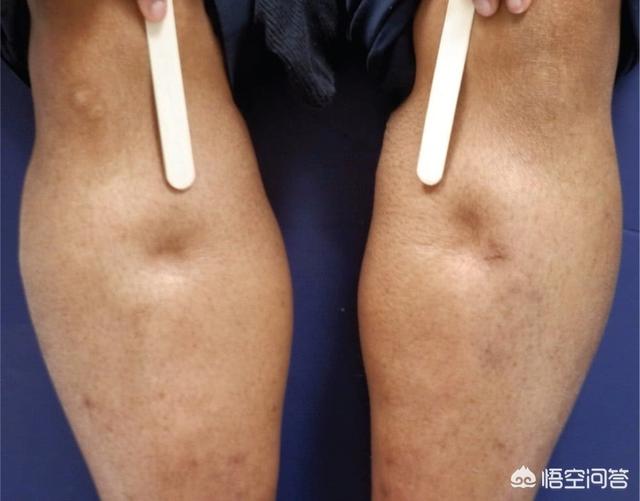 下肢浮肿是怎么回事(下肢浮肿是什么原因引起的)