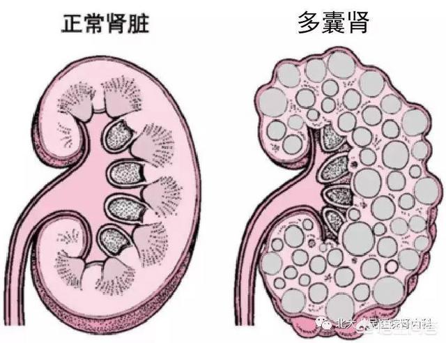 肾囊肿是怎么回事,肾囊肿是怎么回事,需要怎么治疗