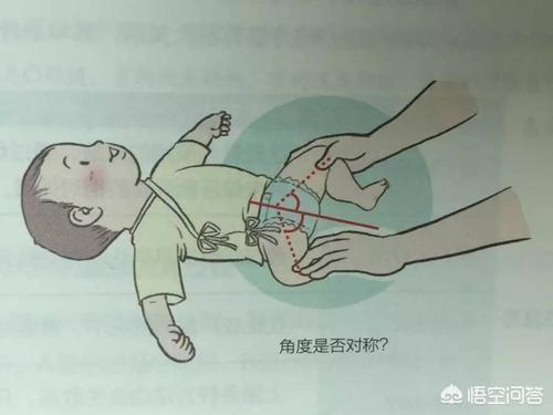 胯关节发育不良:宝宝髋关节发育不良，戴吊带矫正会对以后的走路姿势有影响吗？